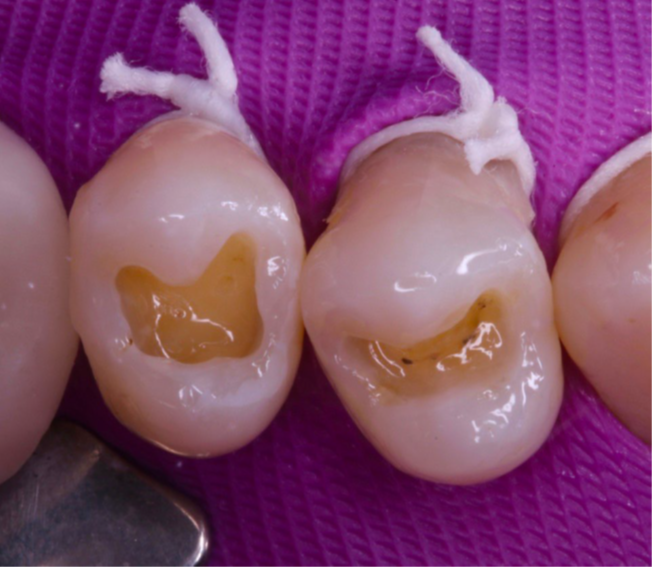 10- Aspecto das superfícies após a aplicação do sisitema adesivo