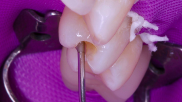 11- Inserção da resina Charisma Bulk Flow ONE
