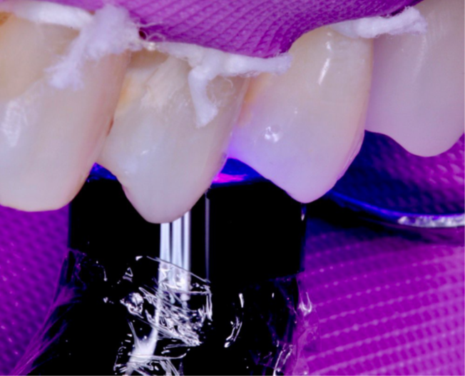 13- Fotoativação da Charisma Bulk Flow ONE por 20 segundos