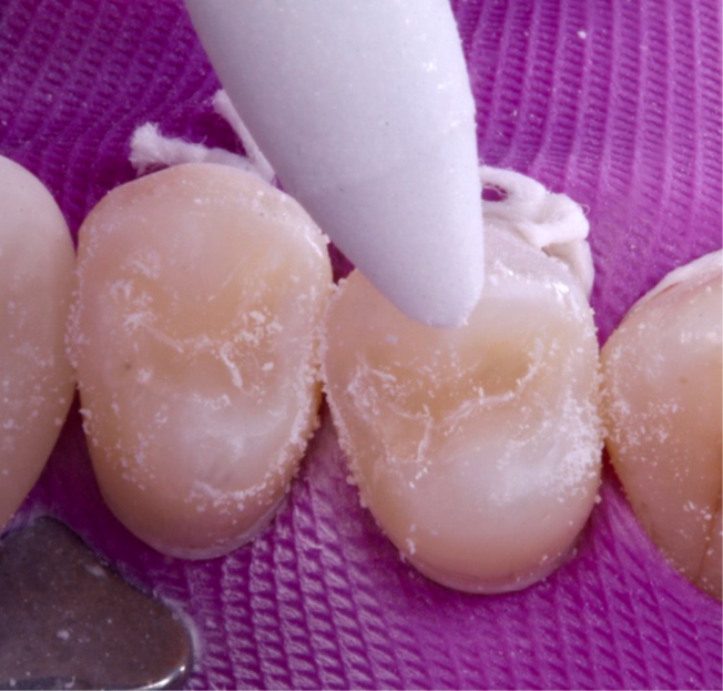 14- Acabamento com as pontas Charisma EasyShine