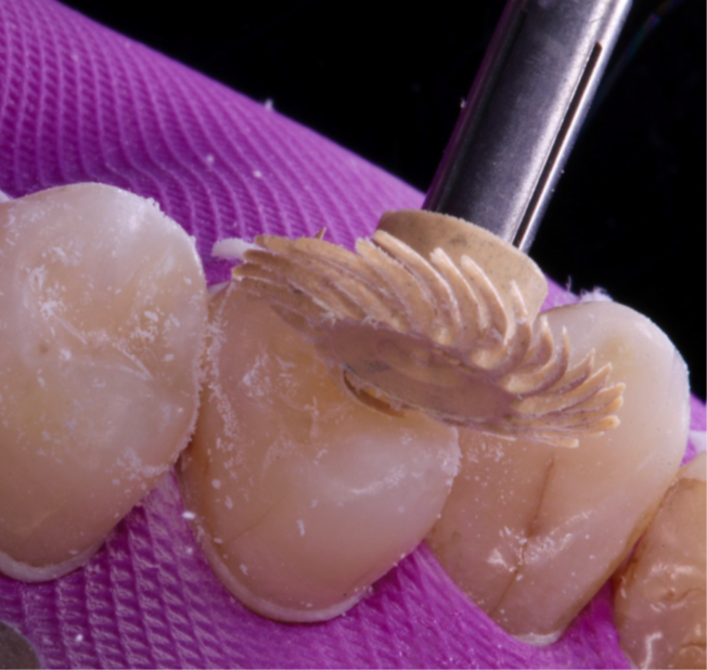 15- Primeira etapa do polimento