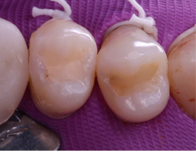 17- Aspecto inicial das restaurações