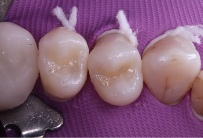 18- Restaurações finalizadas