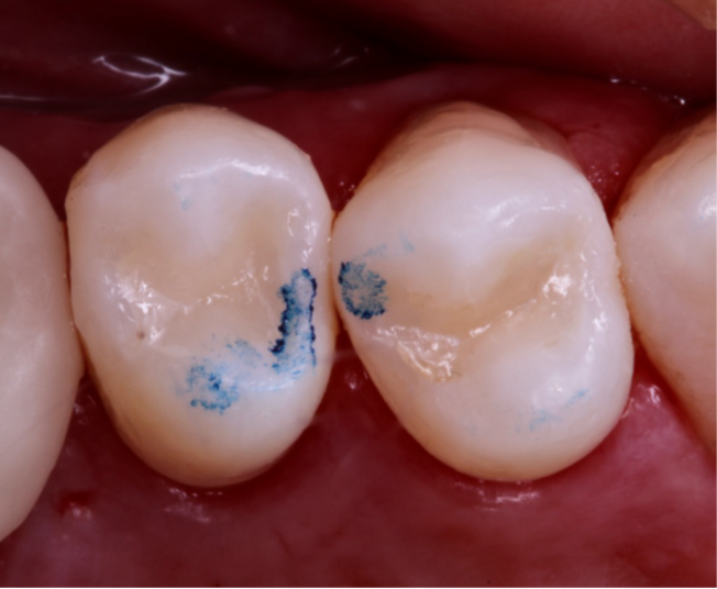 19- Verificação dos pontos de contato e ajuste oclusal