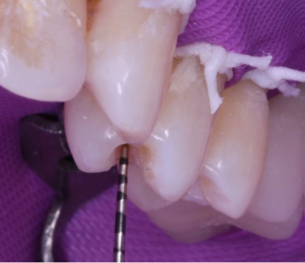 4- Mensuração da profundidade da cavidade do 24 - 2mm