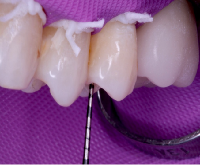 5- Mensuração da cavidade do 25 - 3,5mm