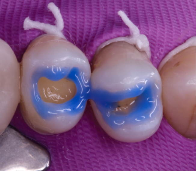 6- Condicionamento seletivo do esmalte Gluma Etch