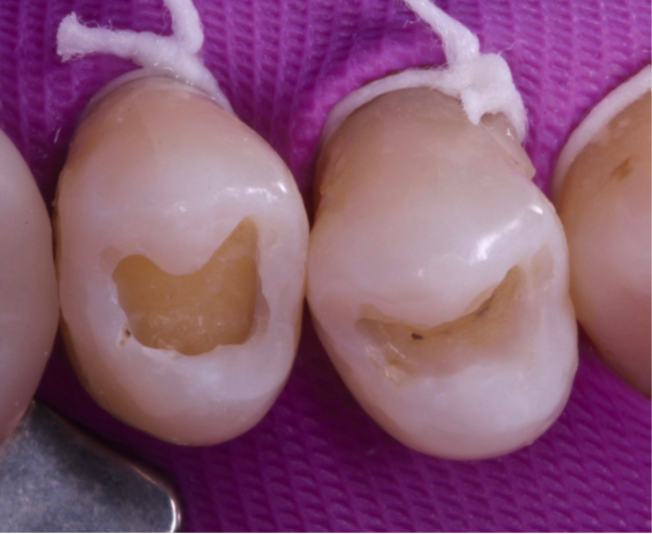 7- Aspecto da superfície de esmalte condicionada