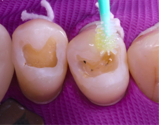 8- Aplicação do sistema adesivo Gluma Bond Universal