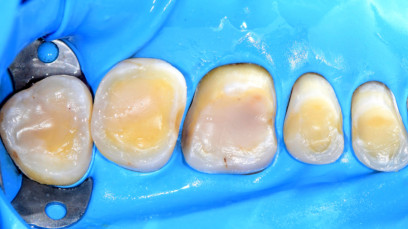 Núcleo de preenchimento com Charisma Bulk Flow ONE