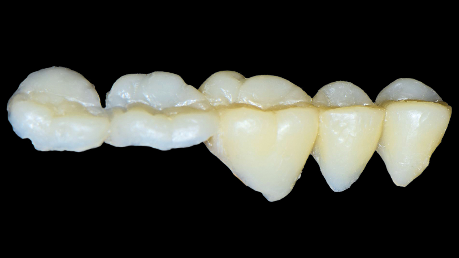 Prótese provisória de 5 elementos preparada fora da boca.