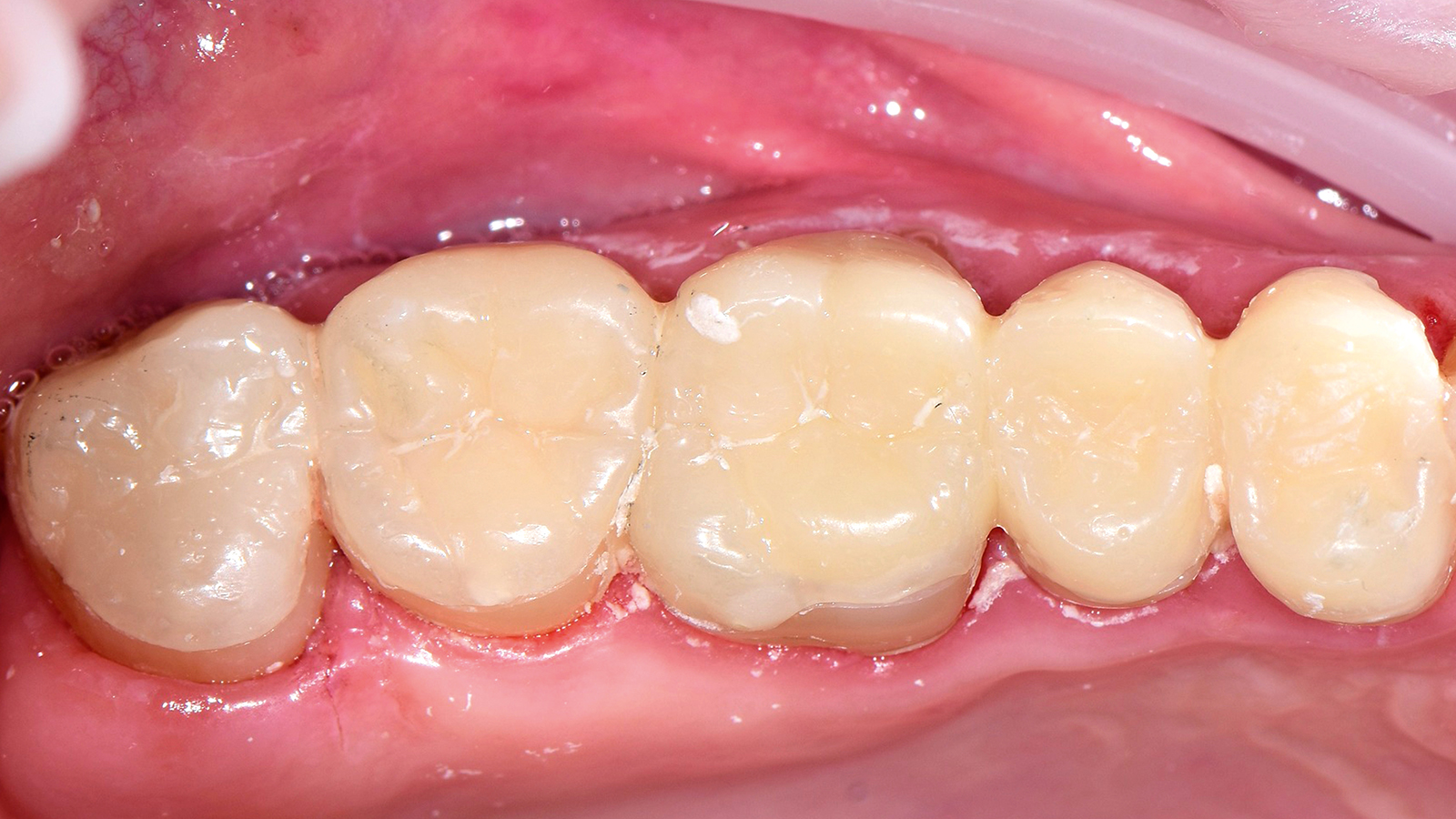 Restaurações provisórias cimentadas com cimento provisório.