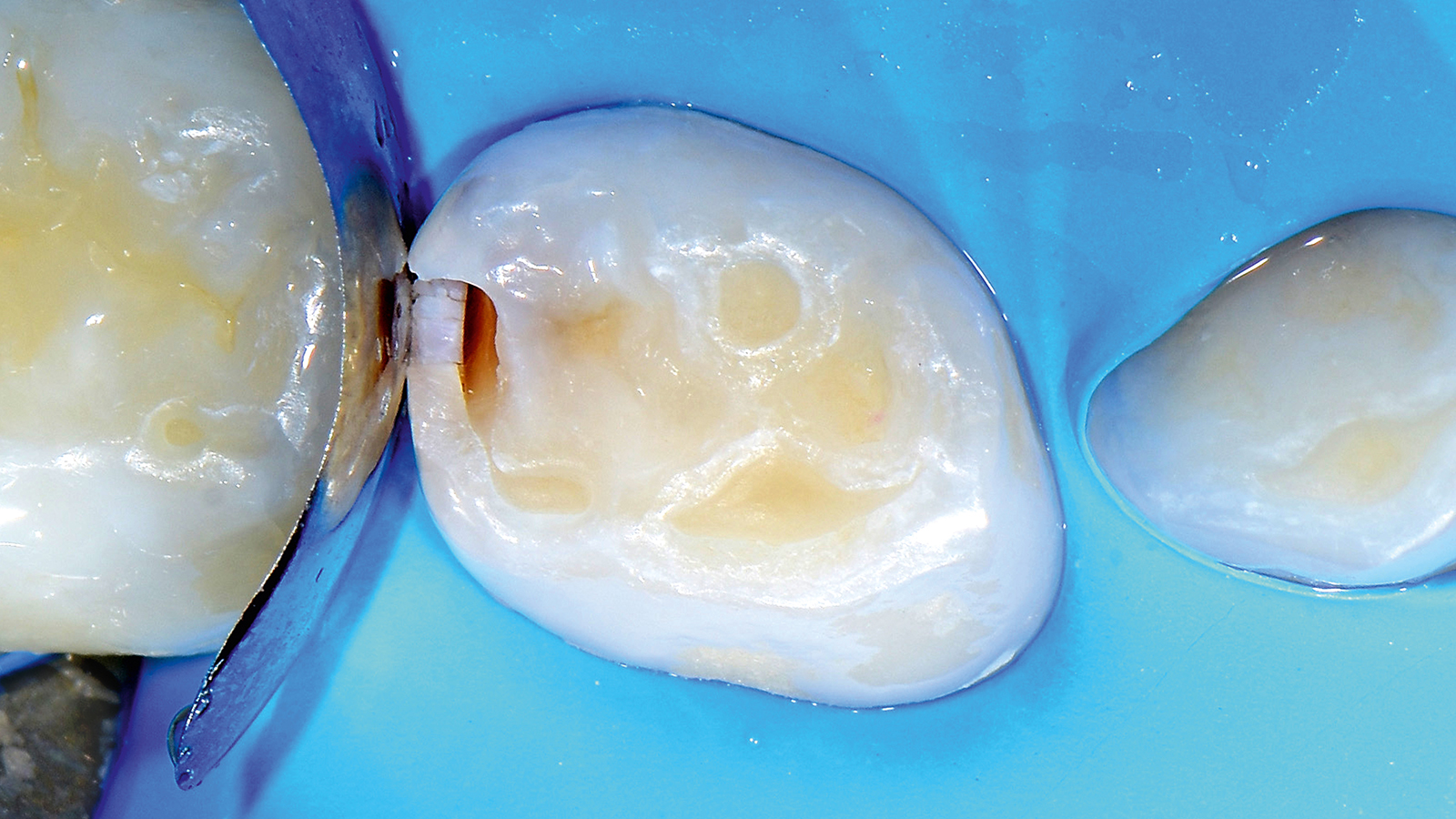 Cavidades abertas, com cárie visível