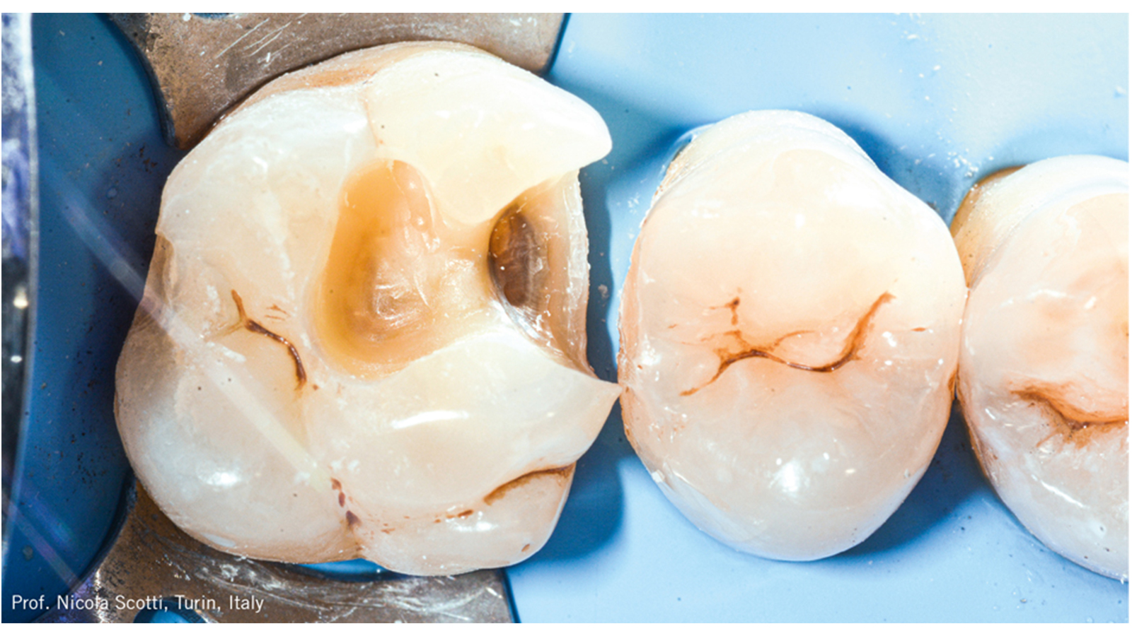 Após o isolamento absoluto foi feita a remoção da cárie e preparo da cavidade.