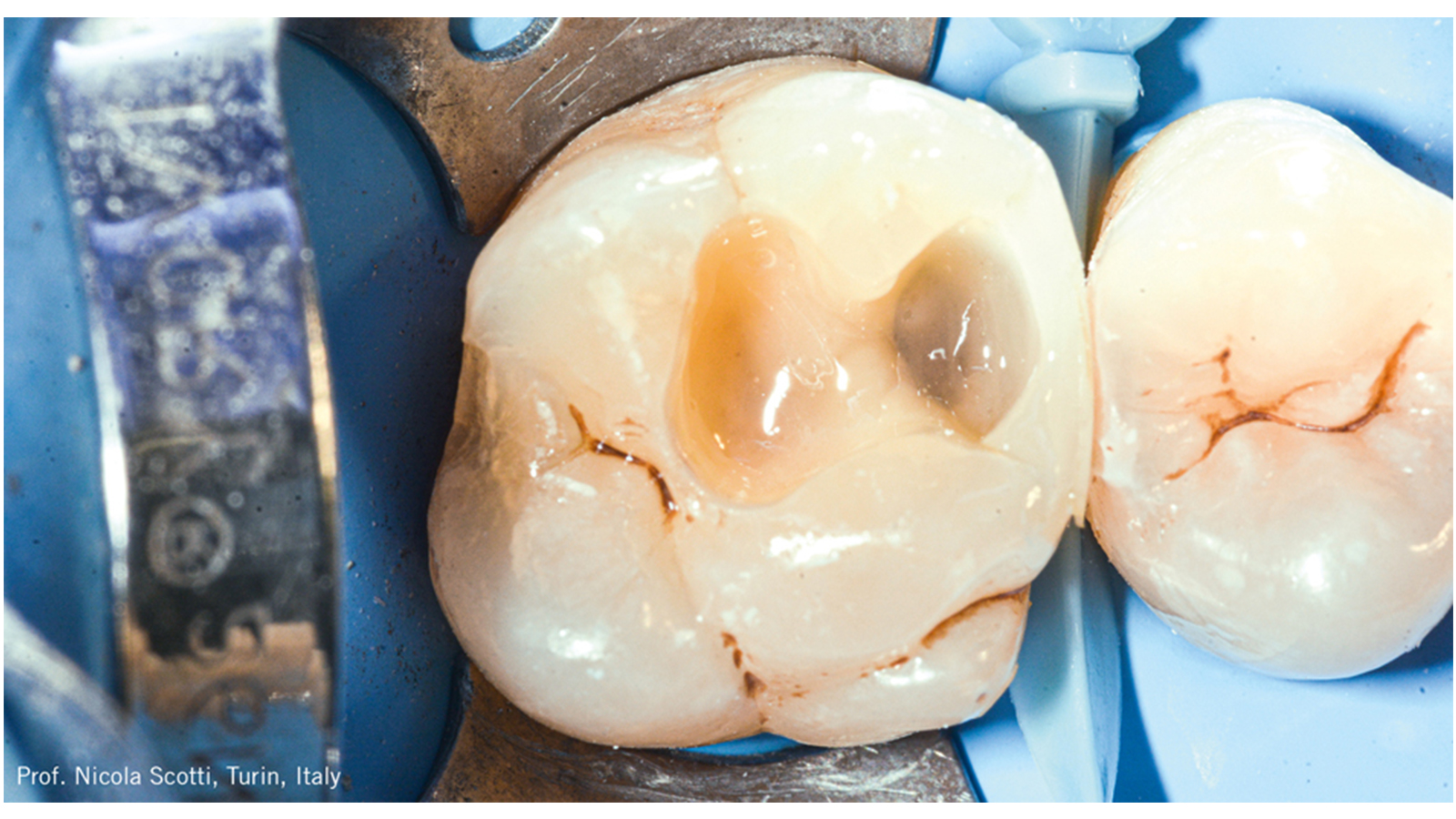 Foi aplicado o GLUMA Bond Universal após um condicionamento seletivo do esmalte.