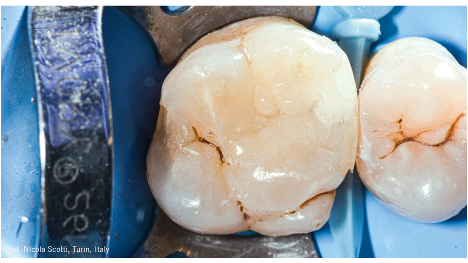 A restauração foi estratificada em uma técnica de estratificação oblíqua usando Charisma Diamond ONE