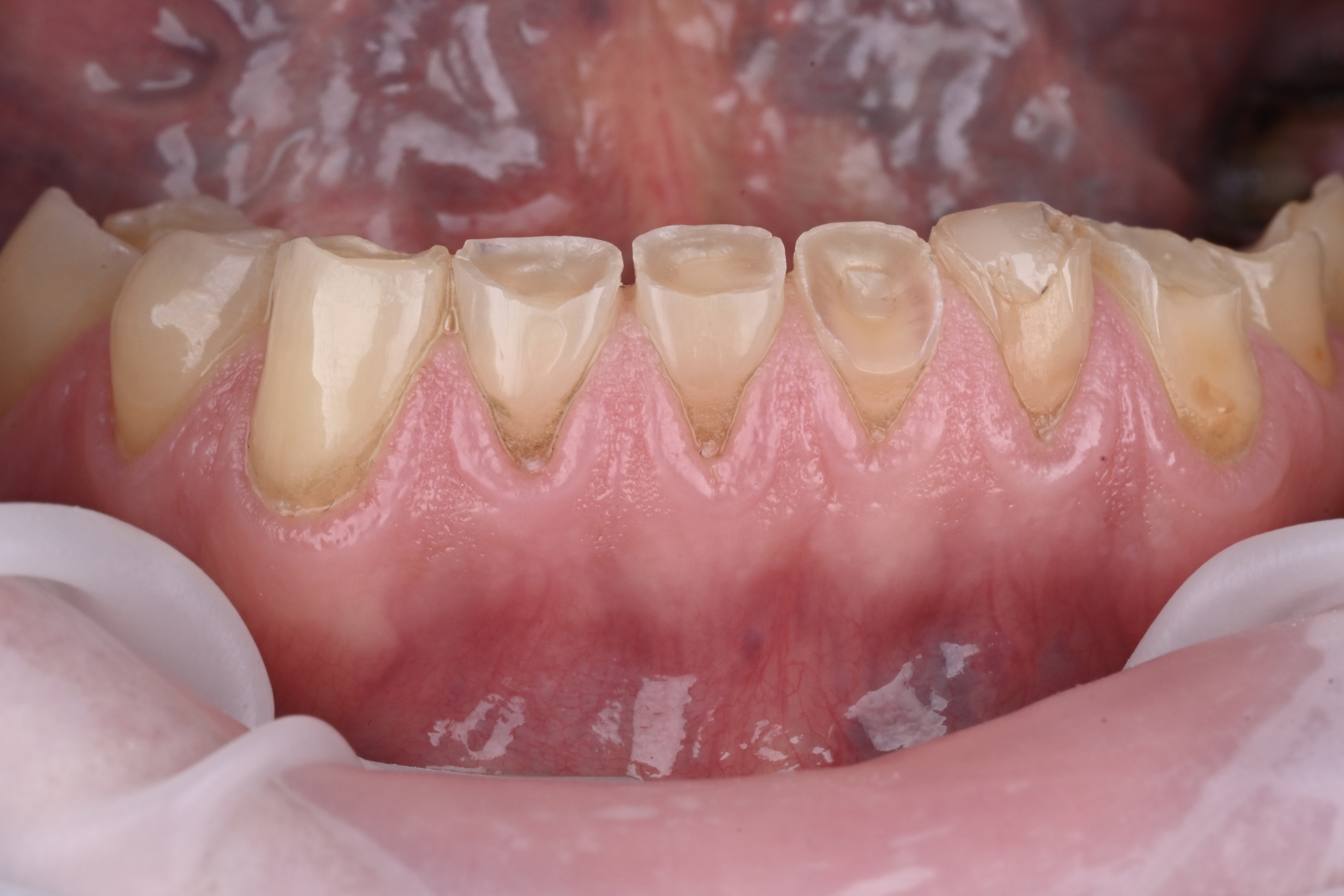 Initial situation with severely abraded lower front teeth.