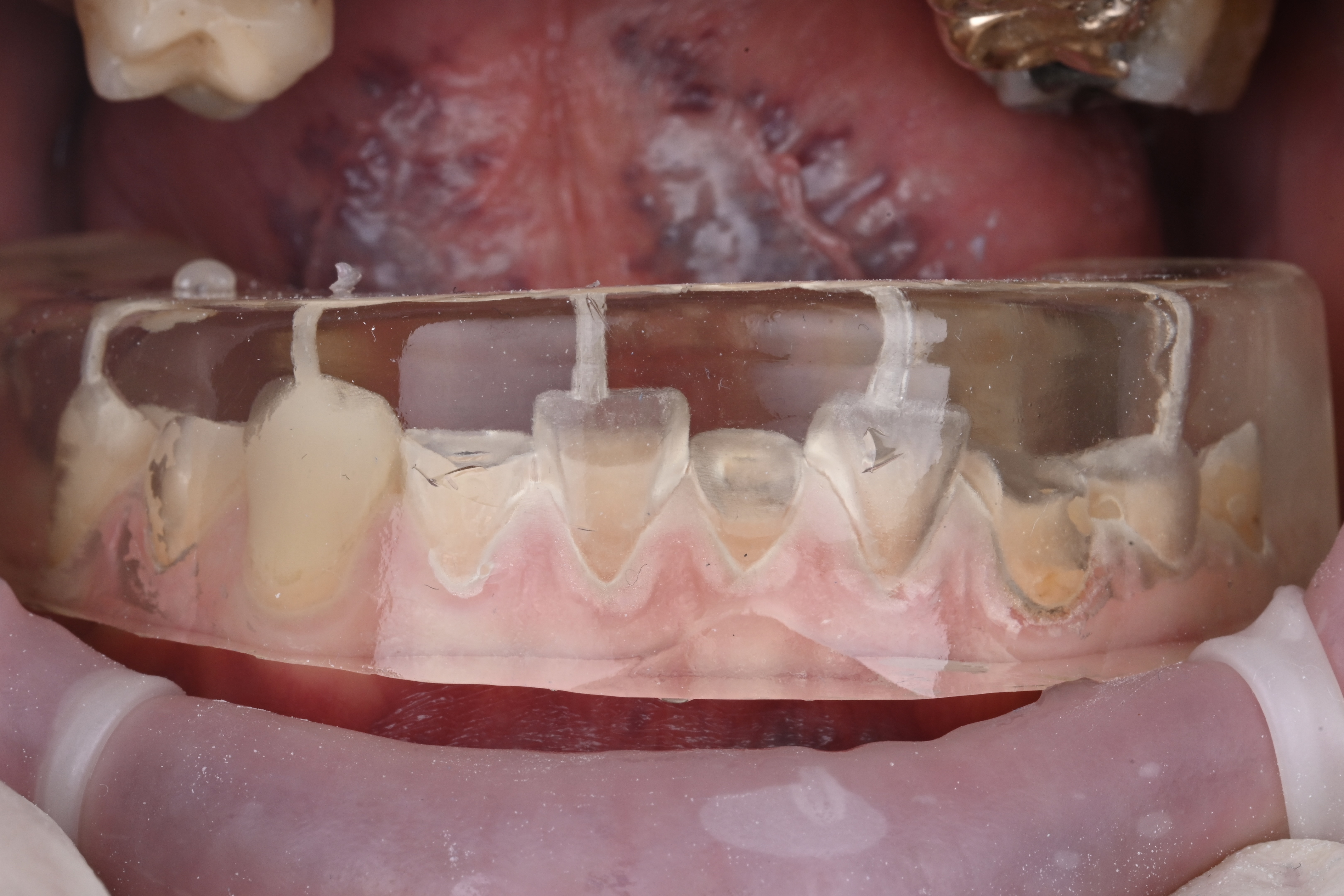 Try-in of transparent keys with holes in the respective teeth.