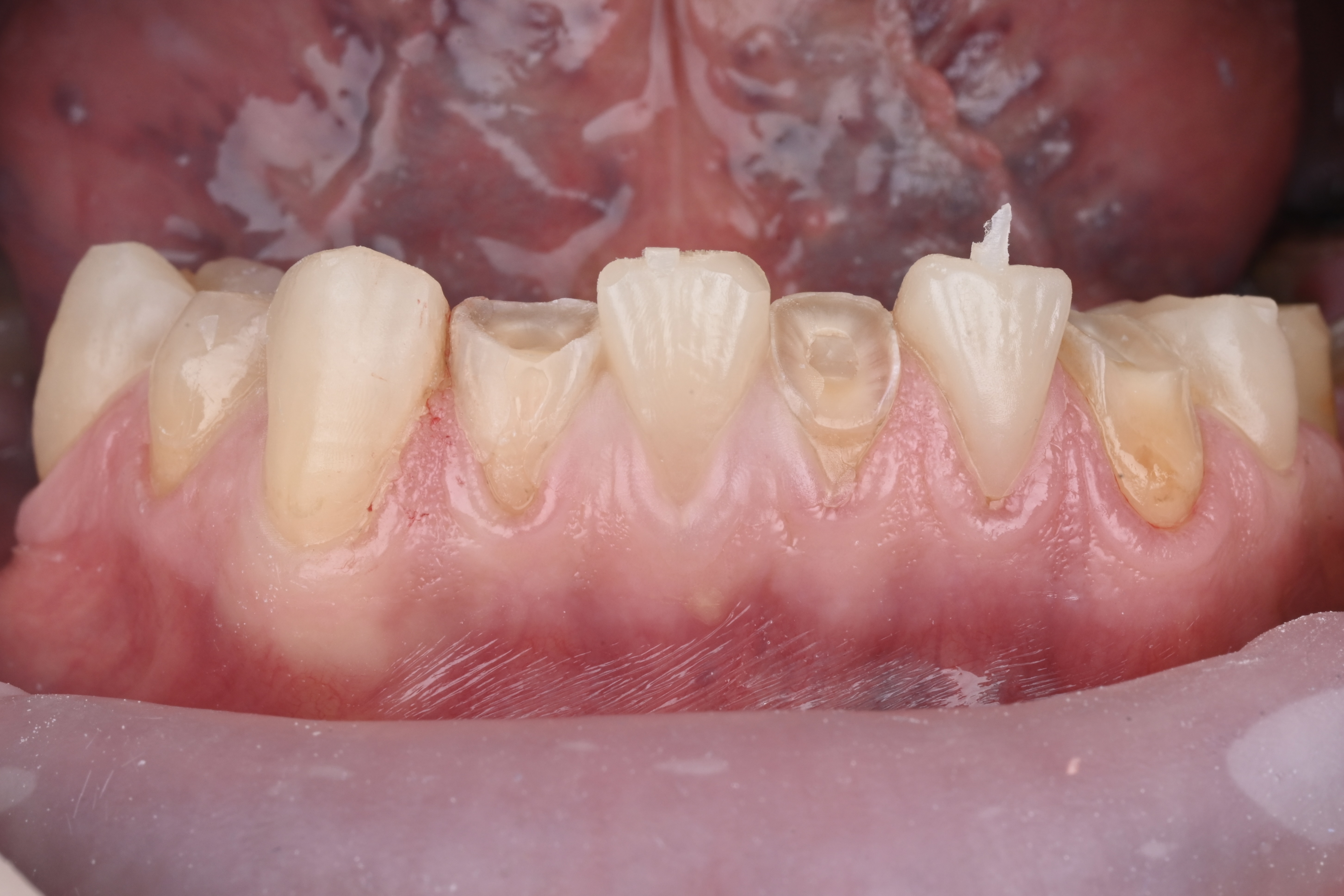 Isolation, etching, bonding and injection of Charisma E4SY Flow LIGHT through the first key; light c