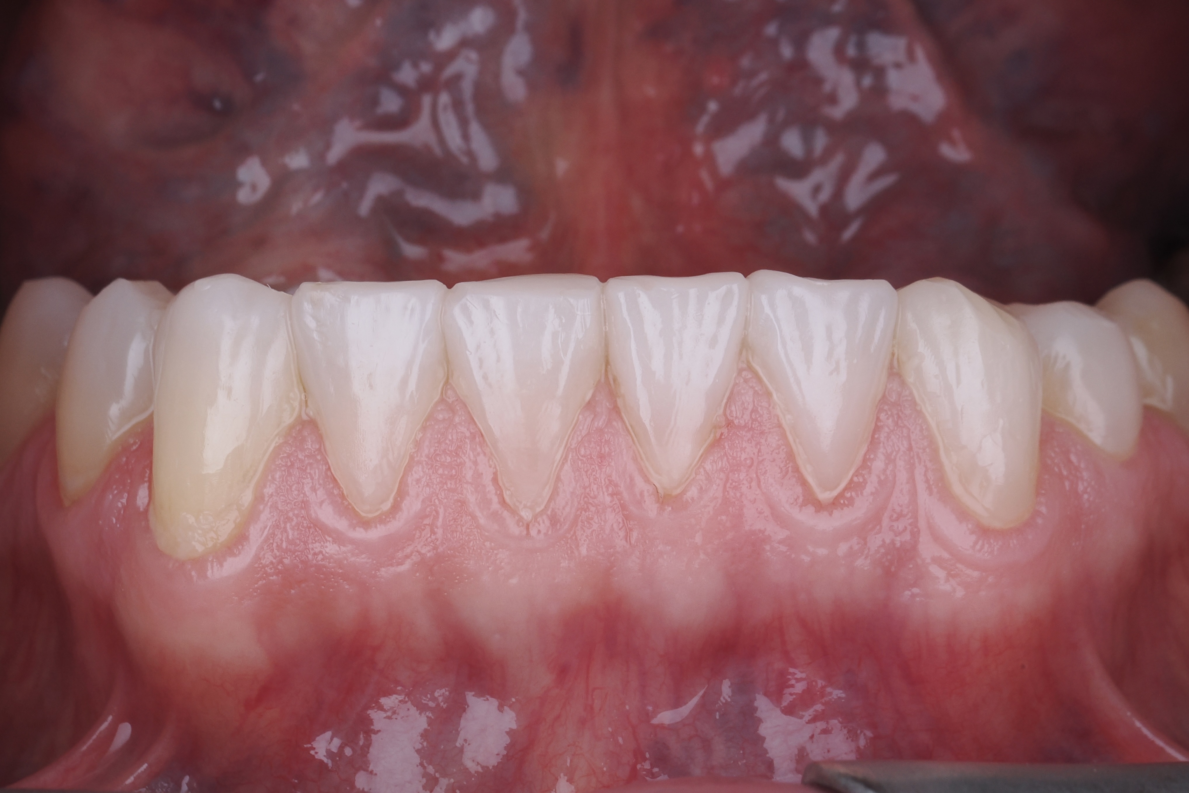 Adjustment of occlusion, finishing and polishing.