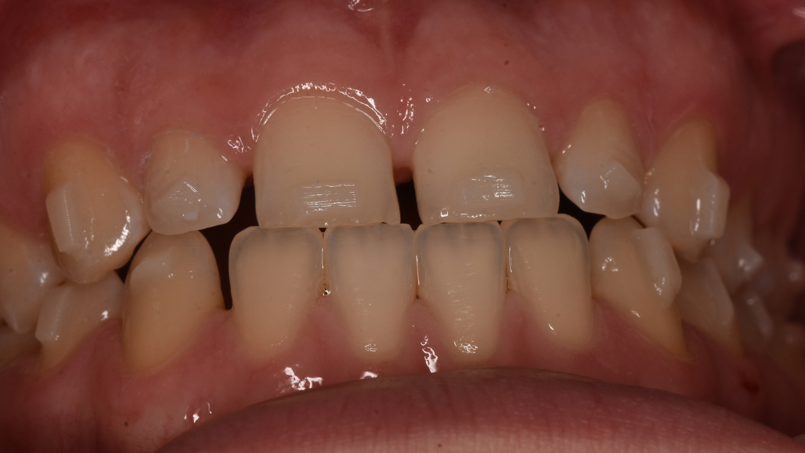 Charisma E4SY Flow is approved for aligner attachments and retainer fixation