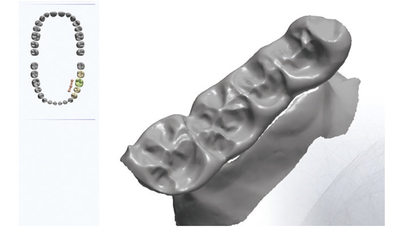 Material escaneável para ser utilizável no fluxo digital, sem a necessidade de uso de spray
